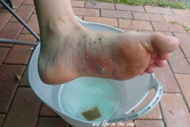 Nicholas Foot Infections